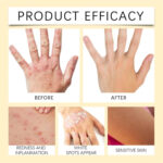 Vitigo Bee Venom Treatment Cream | Natural Skin Repair Hydration Relief Anti-Irritation - Image 8